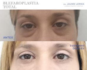 Antes y después Blefaroplastia - Dr. Jaume Lerma Goncé