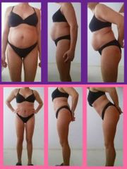 Abdominoplastia - Dr. Jaume Lerma Goncé