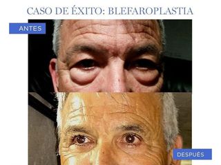 Blefaroplastia - Dr. Jaume Lerma Goncé