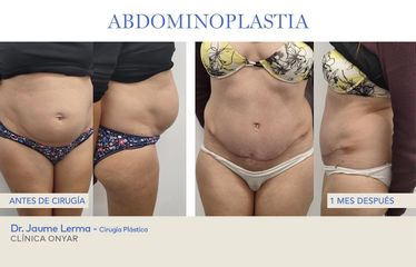Abdominoplastia - Dr. Jaume Lerma Goncé