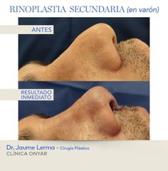 Rinoplastia - Dr. Jaume Lerma Goncé