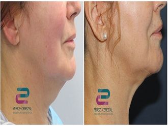 Liposucción - 642296