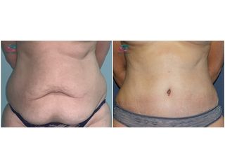 Antes y después Abdominoplastia