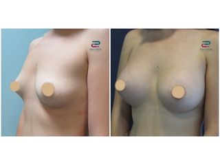 Antes y después Aumento de pecho