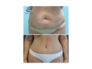 Antes y después Abdominoplastia