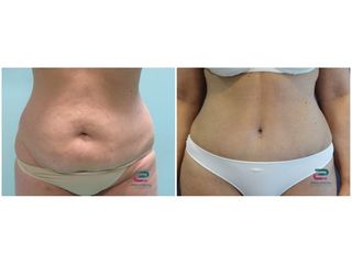 Antes y después Abdominoplastia - Doctor Pérez-Cerezal