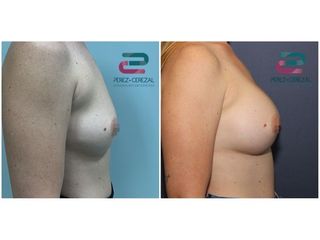 Antes y después Aumento de pecho - Doctor Pérez-Cerezal