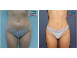 Antes y después Liposucción - Doctor Pérez-Cerezal