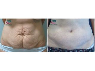 Antes y después Abdominoplastia - Doctor Pérez-Cerezal