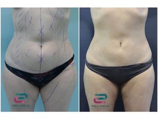 Antes y después Liposucción - Doctor Pérez-Cerezal
