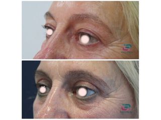 Antes y después Blefaroplastia - Doctor Pérez-Cerezal