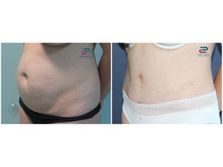 Antes y después Abdominoplastia - Doctor Pérez-Cerezal