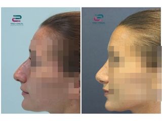 Antes y después Rinoplastia - Doctor Pérez-Cerezal