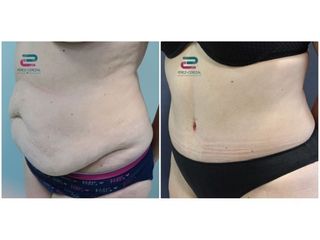Antes y después Abdominoplastia - Doctor Pérez-Cerezal