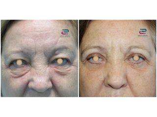 Antes y después Blefaroplastia - Doctor Pérez-Cerezal