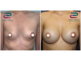 Antes y después Aumento de pecho - Doctor Pérez-Cerezal