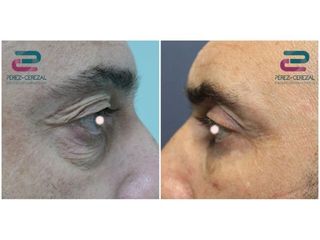 Antes y después Blefaroplastia - Doctor Pérez-Cerezal