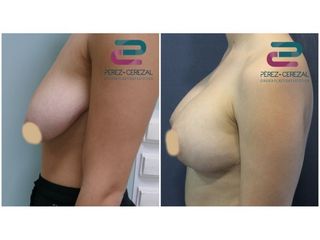 Antes y después Mastopexia - Doctor Pérez-Cerezal