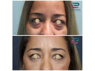 Antes y después Blefaroplastia - Doctor Pérez-Cerezal