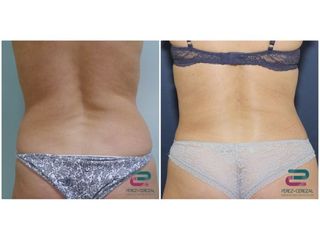 Antes y después Liposucción - Doctor Pérez-Cerezal