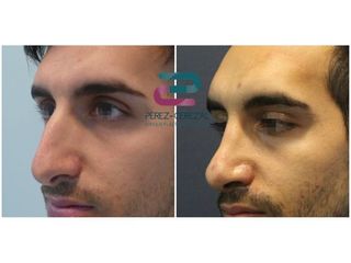 Antes y después Rinoplastia - Doctor Pérez-Cerezal