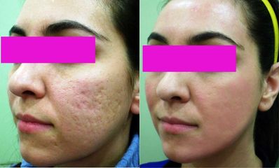 Antes y después Tratamiento anti acné