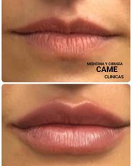 Aumento de labios - Dr. Francisco Pedreño Guerao