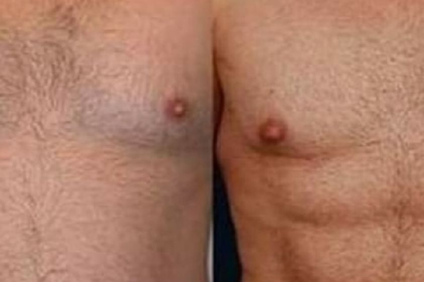 Marcación abdominal antes y después - 853926