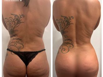 Lipofilling antes y después - 854013
