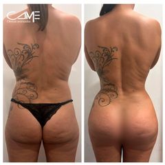 Lipofilling - Dr. Francisco Pedreño Guerao