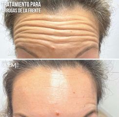 Rellenos faciales - Dr. Francisco Pedreño Guerao