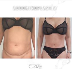 Abdominoplastia - Dr. Francisco Pedreño Guerao