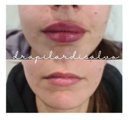 Aumento de labios - Clínica Thous