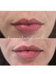 Aumento de labios - Clínica Thous