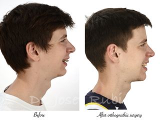 Cirugía maxilofacial - Dr. Josep Rubio Palau