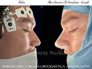 Rinoplastia - Dr. Josep Rubio Palau