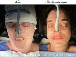 Cirugía maxilofacial - Dr. Josep Rubio Palau