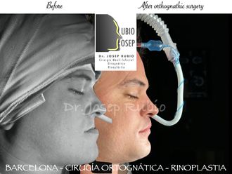Cirugía maxilofacial antes y después - 861288