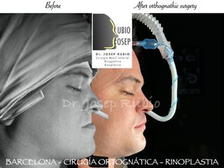 Cirugía maxilofacial - Dr. Josep Rubio Palau