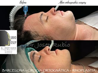 Cirugía maxilofacial antes y después - 861289