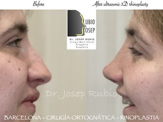 Rinoplastia - Dr. Josep Rubio Palau