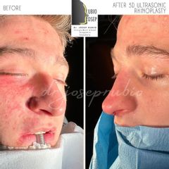 Rinoplastia - Dr. Josep Rubio Palau