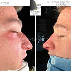 Rinoplastia - Dr. Josep Rubio Palau