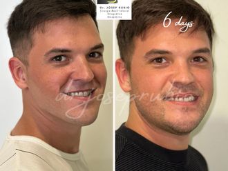 Cirugía maxilofacial antes y después - 861293