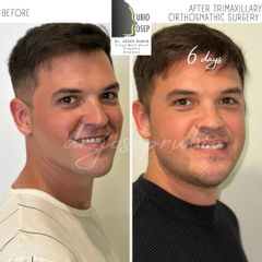 Cirugía maxilofacial - Dr. Josep Rubio Palau