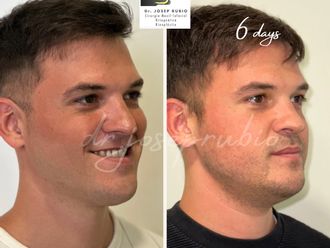 Cirugía maxilofacial antes y después - 861294