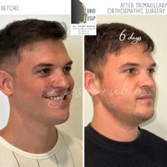 Cirugía maxilofacial - Dr. Josep Rubio Palau