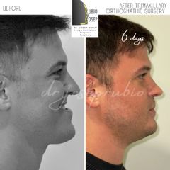 Cirugía maxilofacial - Dr. Josep Rubio Palau