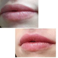 Aumento de labios - Renobell