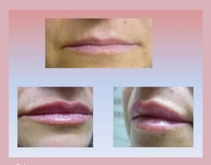 Aumento de labios - Renobell